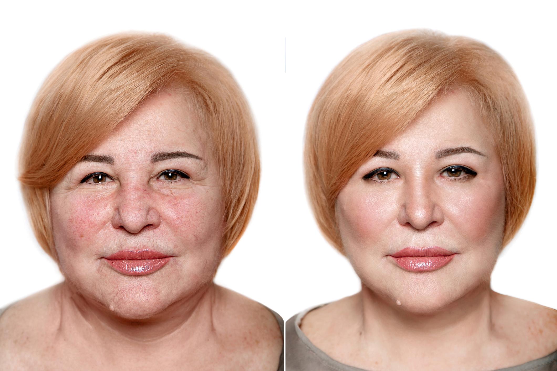 Botox in Guadalajara City